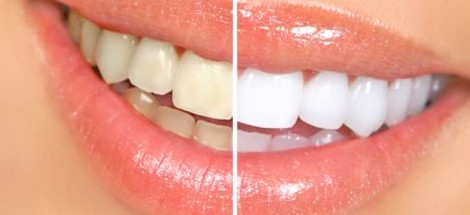 Jak si vybrat gel na domácí bělení zubů?