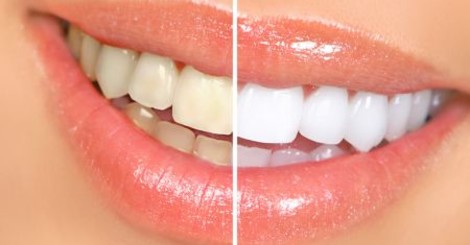 Jak si vybrat gel na domácí bělení zubů?