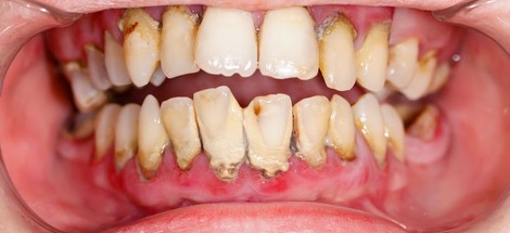 Parodontitida – jak vzniká a co s ní? 