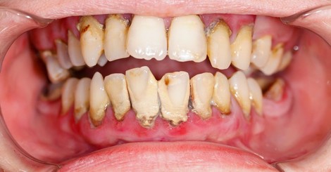 Parodontitida – jak vzniká a co s ní? 