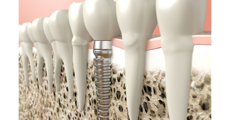 Zubní implantáty a vše o nich