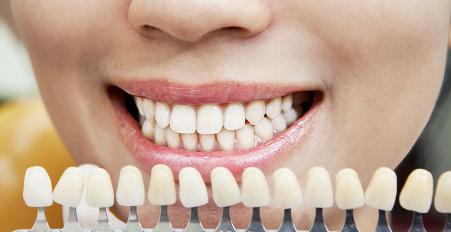 Různé odstíny zubů