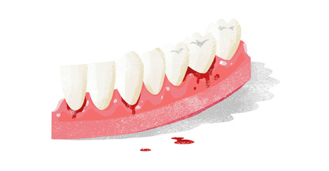 Krvácení dásní aneb zánět, který nebolí + VIDEO