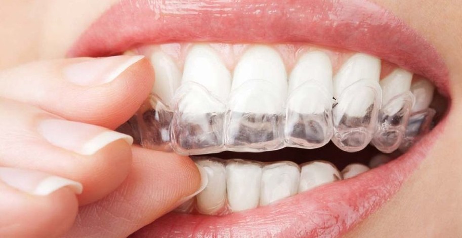 Možnosti domácího bělení zubů