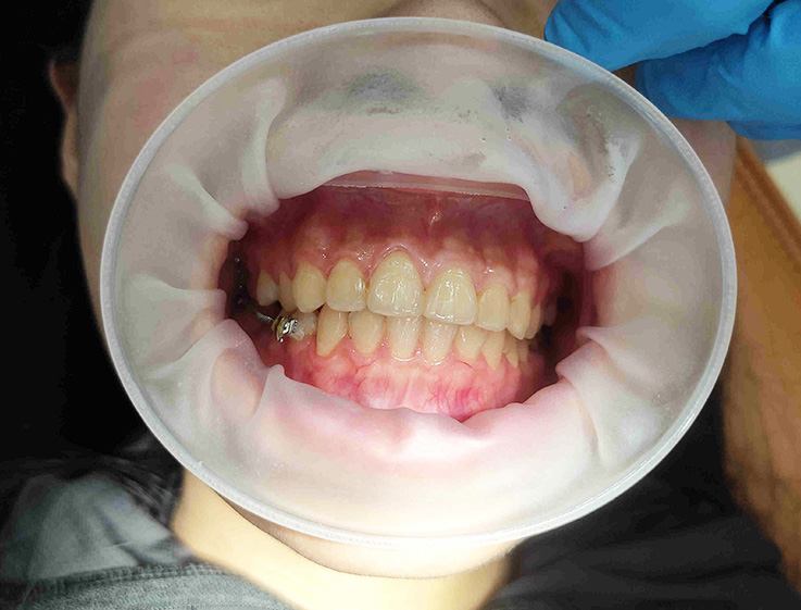 Ztdental rozvěrač 320 ks - Large