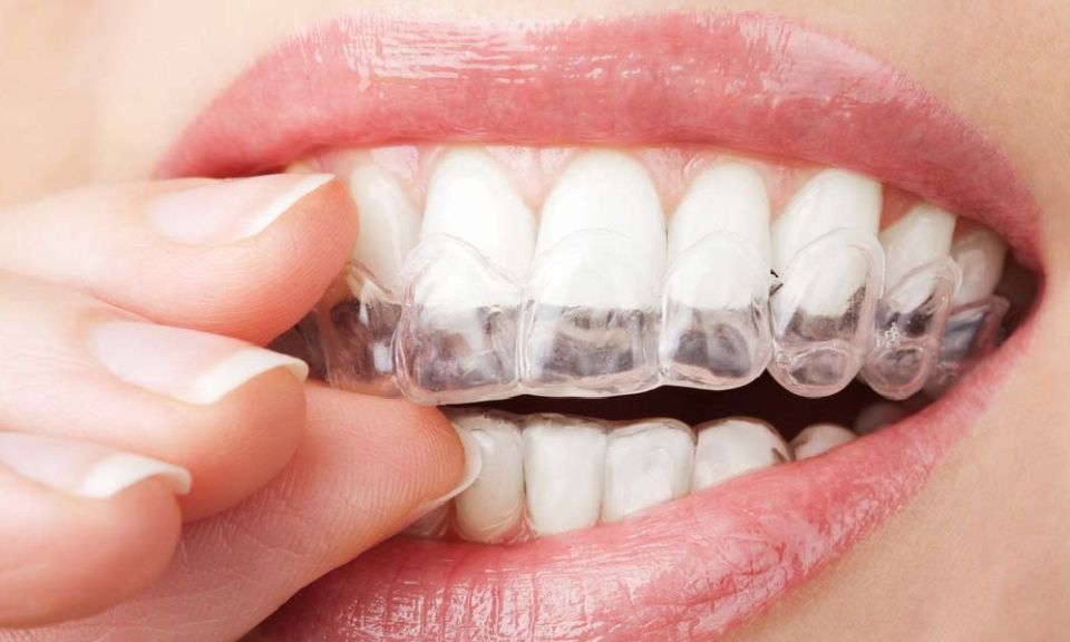 Jak co nejrychleji vybělit zuby?