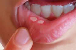 Čo robiť s aftamy v ústach